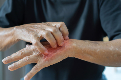 Песчаные мухи нападают на российских туристов на Сейшелах